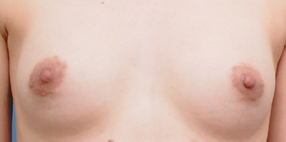 症例写真,乳頭縮小 乳頭が伸びきって大きくなっていた女性の症例,After,ba_nyuto10_b.jpg