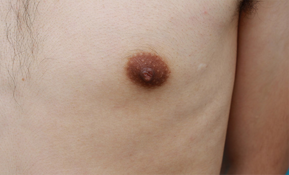症例写真,男性の乳頭縮小手術の症例写真,Before,ba_nyuto23_b.jpg