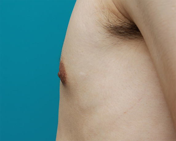 症例写真,男性の乳頭縮小手術の症例写真,After（1ヶ月後）,ba_nyuto24_b.jpg