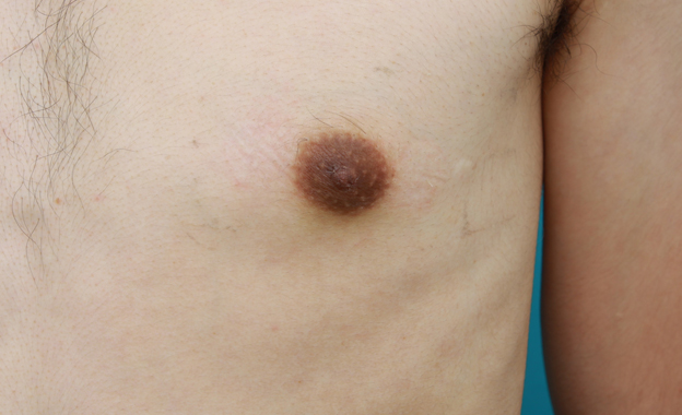 症例写真,男性の乳頭縮小手術の症例写真,10日後,mainpic_nyuto03c.jpg