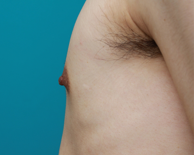 症例写真,男性の乳頭縮小手術の症例写真,施術前,mainpic_nyuto03e.jpg