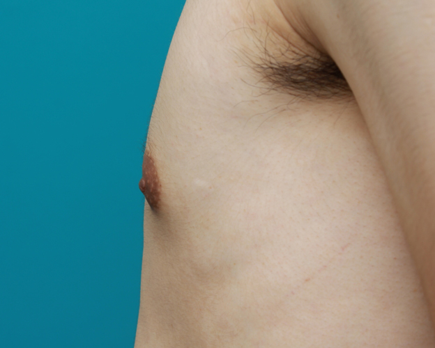症例写真,男性の乳頭縮小手術の症例写真,1ヶ月後,mainpic_nyuto03h.jpg