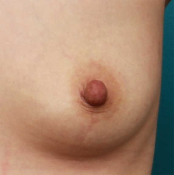 乳頭縮小の症例 バストの脂肪注入手術と同時に乳頭縮小も施術,Before,ba_nyuto25_b.jpg