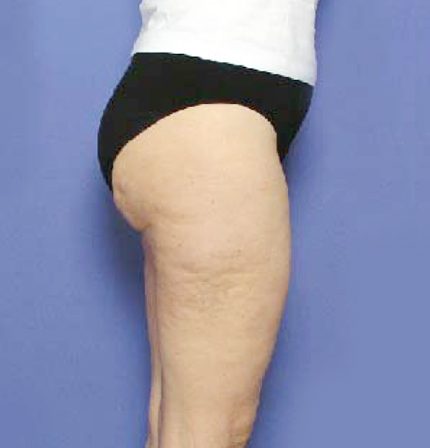 症例写真,イタリアン・メソシェイプ（イタリアンメソセラピー）・脂肪溶解注射　ふともも外側前側・おしり,After,ba_meso23_b.jpg