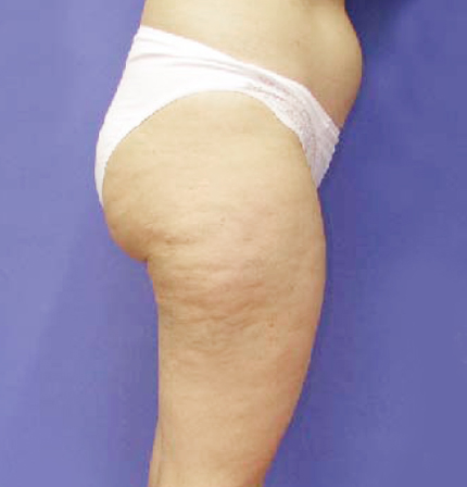 症例写真,イタリアン・メソシェイプ（イタリアンメソセラピー）・脂肪溶解注射の症例　ふともも外側前側・おしり,Before,ba_meso23_b.jpg
