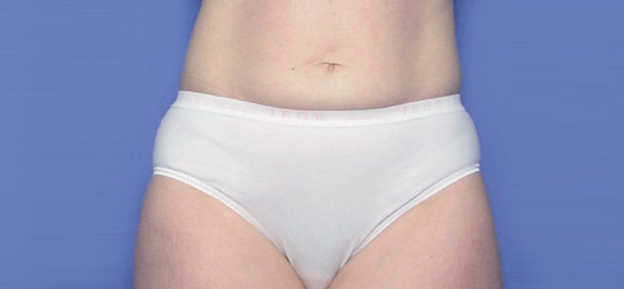 イタリアン・メソシェイプ（イタリアンメソセラピー）・脂肪溶解注射の症例 腹部まわりのたるみを気にされていた女性,After,ba_meso15_a01.jpg
