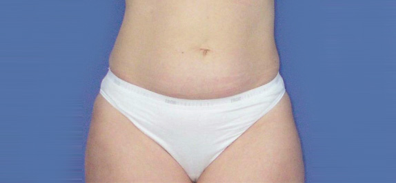 イタリアン・メソシェイプ（イタリアンメソセラピー）・脂肪溶解注射の症例 腹部まわりのたるみを気にされていた女性,Before,ba_meso15_b.jpg