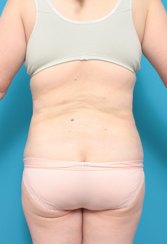 症例写真,50代女性のたるんだお腹まわりに大量の脂肪吸引をした症例写真,After,ba_shibokyuin68_b.jpg
