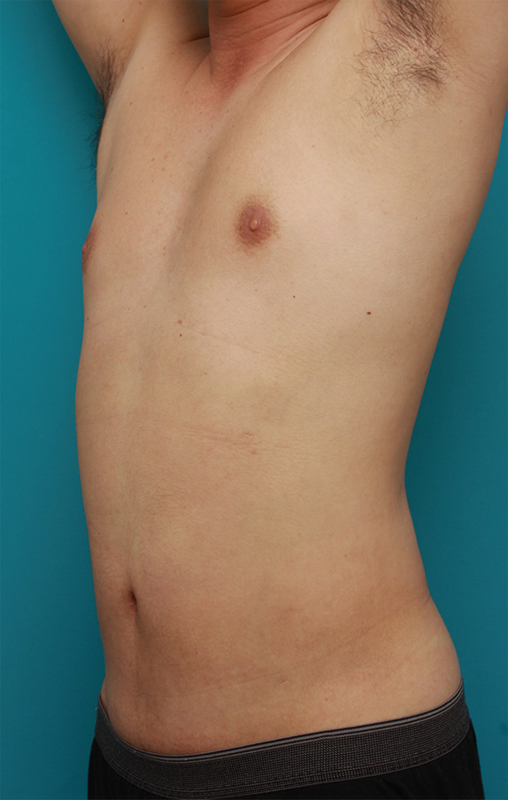 症例写真,30代男性のお腹、わき腹、背中、腰の脂肪吸引をした症例写真,After（1年後）,ba_shibokyuin70_b.jpg