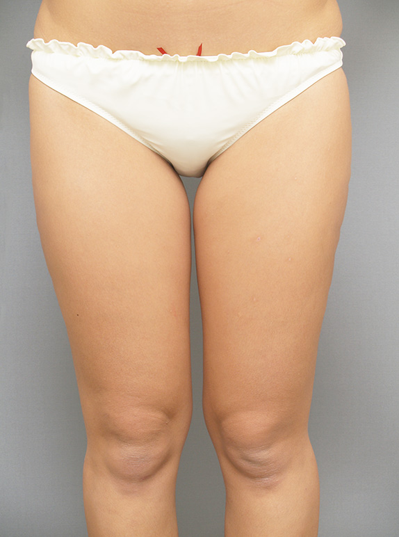 症例写真,イタリアン・メソシェイプ（イタリアンメソセラピー）・脂肪溶解注射　おしりと太腿全体,After,ba_meso21_b.jpg