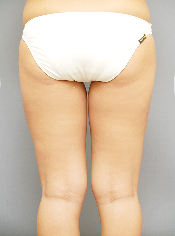 症例写真,イタリアン・メソシェイプ（イタリアンメソセラピー）・脂肪溶解注射　おしりと太腿全体,After,ba_meso22_b.jpg