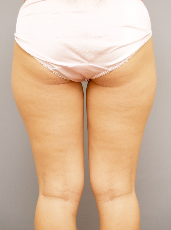 症例写真,イタリアン・メソシェイプ（イタリアンメソセラピー）・脂肪溶解注射の症例　おしりと太腿全体,Before,ba_meso22_b.jpg