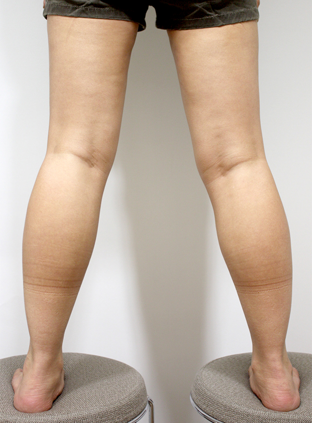 症例写真,イタリアン・メソシェイプ（イタリアンメソセラピー）・脂肪溶解注射の症例　ふくらはぎ,Before,ba_meso19_b.jpg