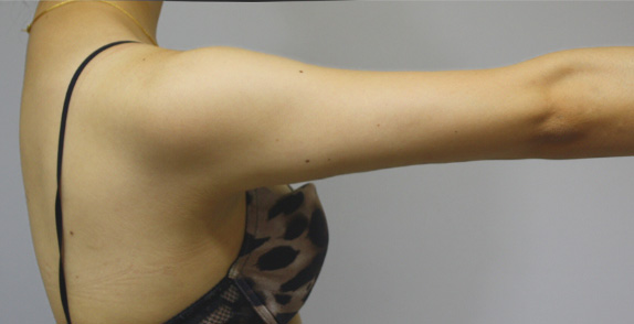症例写真,イタリアン・メソシェイプ（イタリアンメソセラピー）・脂肪溶解注射　二の腕,After6回終了後（3ヶ月後）,ba_meso18_b.jpg
