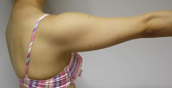 症例写真,イタリアン・メソシェイプ（イタリアンメソセラピー）・脂肪溶解注射　二の腕,Before,ba_meso18_b.jpg