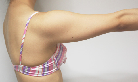 症例写真,イタリアン・メソシェイプ（イタリアンメソセラピー）・脂肪溶解注射　二の腕,施術前,mainpic_meso_02a.jpg
