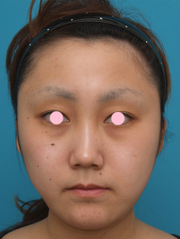 症例写真,顔のイタリアン・メソシェイプ（イタリアンメソセラピー）・脂肪溶解注射の症例写真,After（メイクなし）,ba_meso32_b.jpg