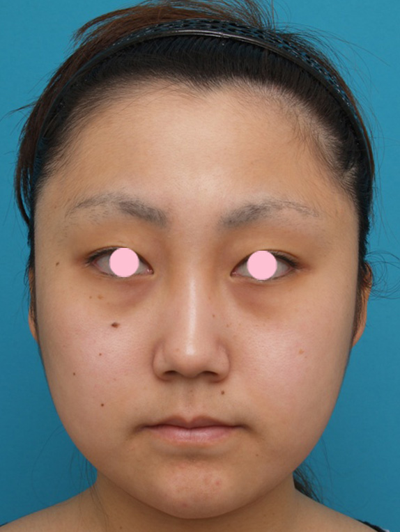 顔のイタリアン・メソシェイプ（イタリアンメソセラピー）・脂肪溶解注射の症例写真,Before,ba_meso32_b.jpg