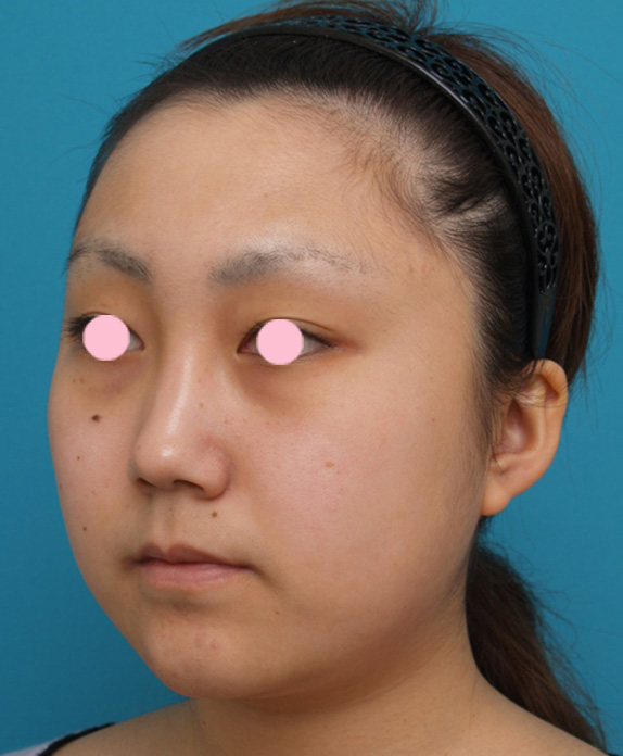 症例写真,顔のイタリアン・メソシェイプ（イタリアンメソセラピー）・脂肪溶解注射の症例写真,Before,ba_meso33_b.jpg