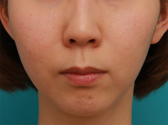 ヒアルロン酸注射で、顎を出しつつ、梅干しジワを改善させた症例写真の術前術後画像,Before,ba_agochu33_b.jpg
