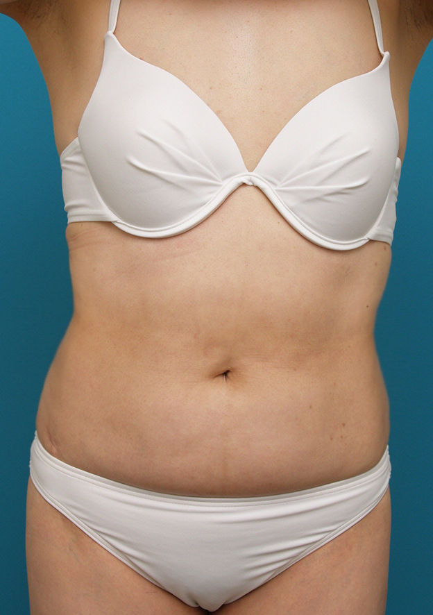 症例写真,お腹周りのイタリアン・メソシェイプ（イタリアンメソセラピー）・脂肪溶解注射症例写真,After,ba_meso35_b.jpg