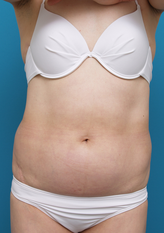 症例写真,お腹周りのイタリアン・メソシェイプ（イタリアンメソセラピー）・脂肪溶解注射症例写真,Before,ba_meso35_b.jpg