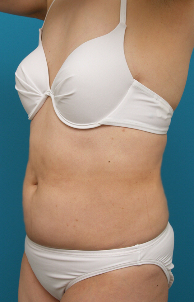症例写真,お腹周りのイタリアン・メソシェイプ（イタリアンメソセラピー）・脂肪溶解注射症例写真,After,ba_meso36_b.jpg