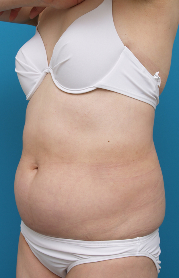症例写真,お腹周りのイタリアン・メソシェイプ（イタリアンメソセラピー）・脂肪溶解注射症例写真,Before,ba_meso36_b.jpg