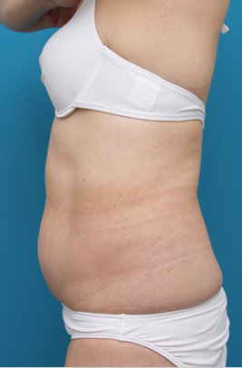 症例写真,お腹周りのイタリアン・メソシェイプ（イタリアンメソセラピー）・脂肪溶解注射症例写真,Before,ba_meso37_b.jpg