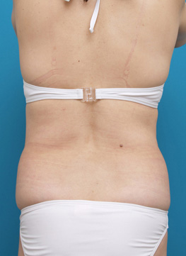 症例写真,お腹周りのイタリアン・メソシェイプ（イタリアンメソセラピー）・脂肪溶解注射症例写真,Before,ba_meso38_b.jpg