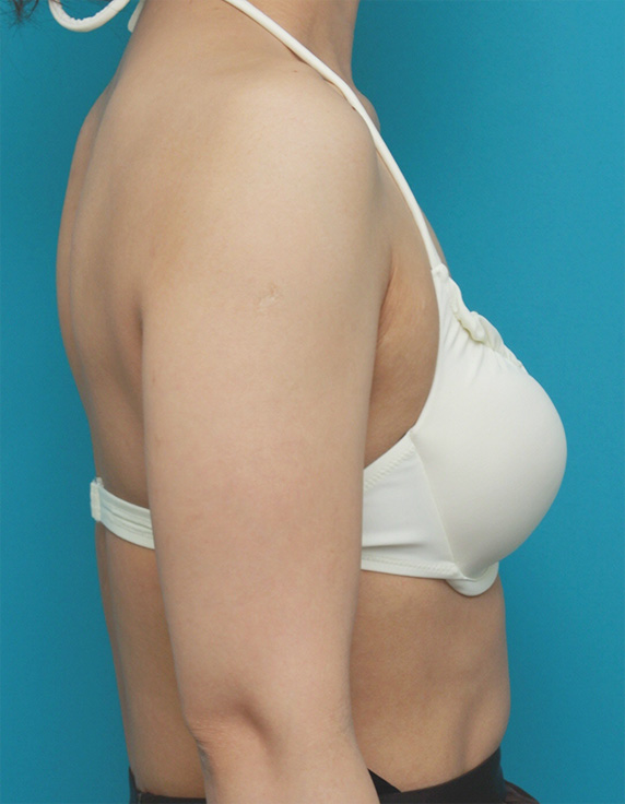 症例写真,二の腕イタリアン・メソシェイプ（イタリアンメソセラピー）・脂肪溶解注射症例写真,Before,ba_meso39_b.jpg