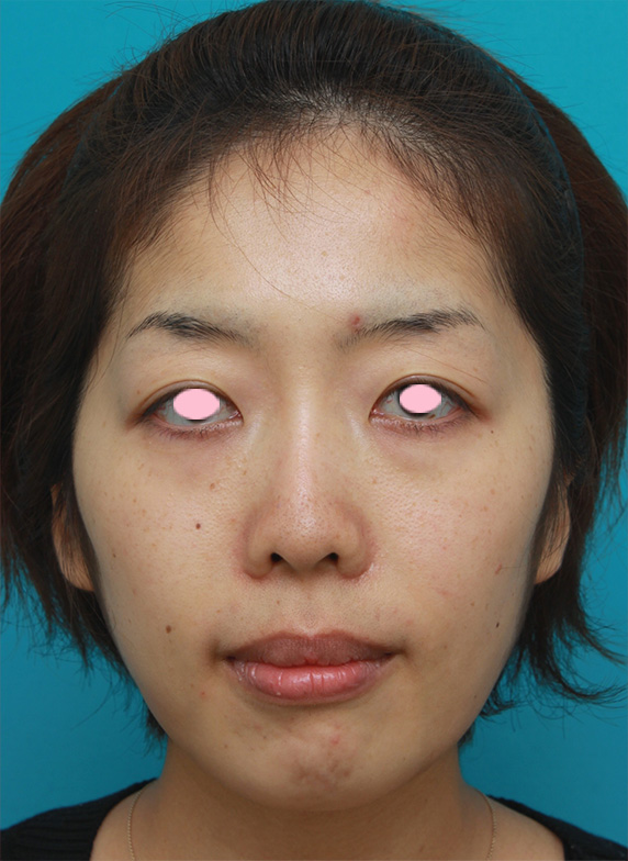症例写真,頬とフェイスラインのイタリアン・メソシェイプ（イタリアンメソセラピー）・脂肪溶解注射で小顔になった症例写真,After（3回注射後2ヶ月）,ba_meso42_b.jpg
