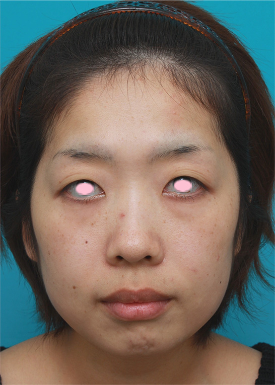 症例写真,頬とフェイスラインのイタリアン・メソシェイプ（イタリアンメソセラピー）・脂肪溶解注射で小顔になった症例写真,注射前,mainpic_meso_03a.jpg