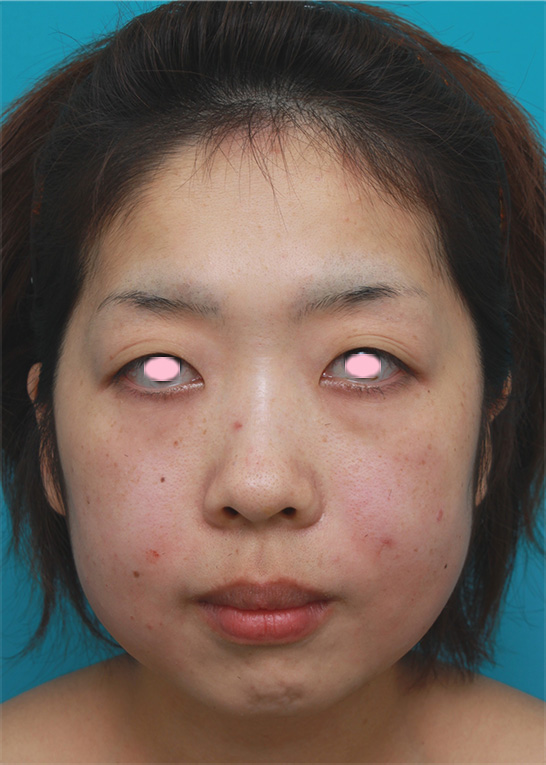 症例写真,頬とフェイスラインのイタリアン・メソシェイプ（イタリアンメソセラピー）・脂肪溶解注射で小顔になった症例写真,注射直後,mainpic_meso_03b.jpg