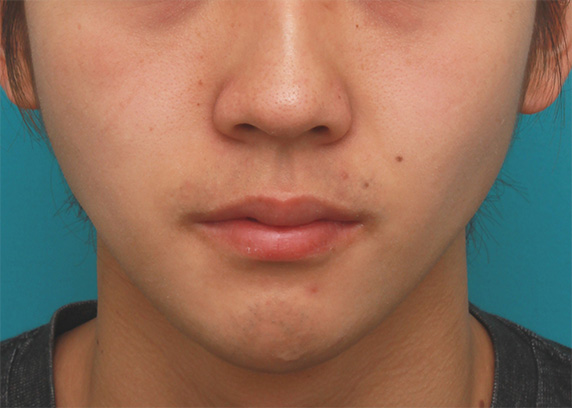 顎にヒアルロン酸注射をし、程よく尖ったシャープなフェイスラインを作った症例写真の術前術後画像,After（1週間後）,ba_agochu36_a01.jpg