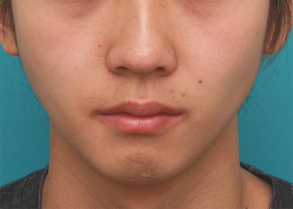 顎にヒアルロン酸注射をし、程よく尖ったシャープなフェイスラインを作った症例写真の術前術後画像,Before,ba_agochu36_b.jpg