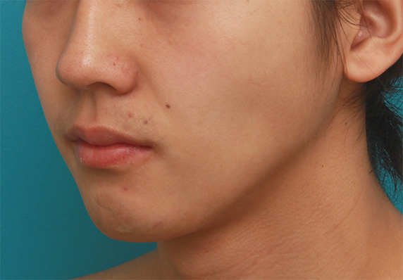 症例写真,顎にヒアルロン酸注射をし、程よく尖ったシャープなフェイスラインを作った症例写真の術前術後画像,After（1週間後）,ba_agochu37_b.jpg