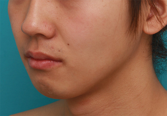 症例写真,顎にヒアルロン酸注射をし、程よく尖ったシャープなフェイスラインを作った症例写真の術前術後画像,Before,ba_agochu37_b.jpg