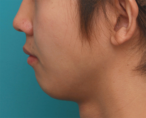 症例写真,顎にヒアルロン酸注射をし、程よく尖ったシャープなフェイスラインを作った症例写真の術前術後画像,Before,ba_agochu38_b.jpg