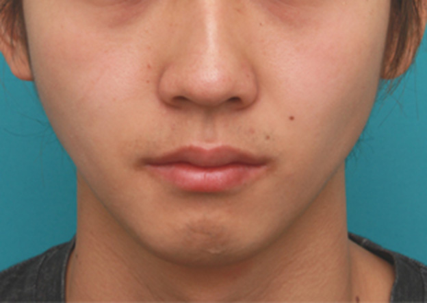 症例写真,顎にヒアルロン酸注射をし、程よく尖ったシャープなフェイスラインを作った症例写真の術前術後画像,注射前,mainpic_agochu02a.jpg
