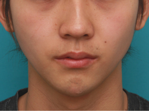 症例写真,顎にヒアルロン酸注射をし、程よく尖ったシャープなフェイスラインを作った症例写真の術前術後画像,注射直後,mainpic_agochu02b.jpg