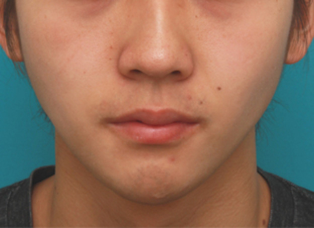 症例写真,顎にヒアルロン酸注射をし、程よく尖ったシャープなフェイスラインを作った症例写真の術前術後画像,1週間後,mainpic_agochu02c.jpg
