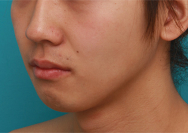 症例写真,顎にヒアルロン酸注射をし、程よく尖ったシャープなフェイスラインを作った症例写真の術前術後画像,注射前,mainpic_agochu02d.jpg
