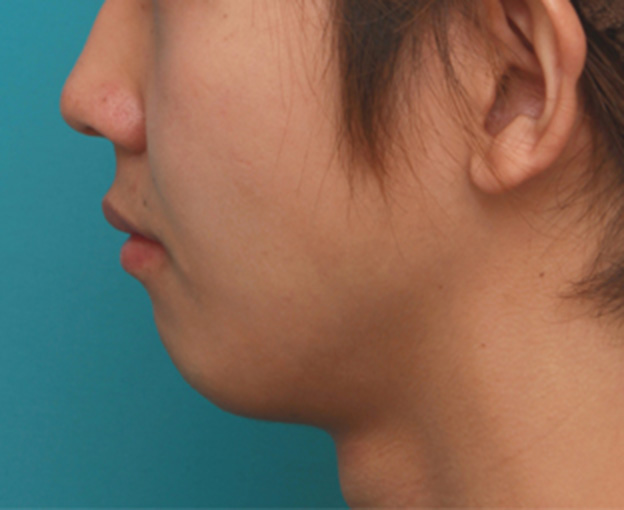 症例写真,顎にヒアルロン酸注射をし、程よく尖ったシャープなフェイスラインを作った症例写真の術前術後画像,注射前,mainpic_agochu02g.jpg