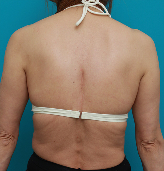 症例写真,ブラジャーの上に乗っかる背中の肉をイタリアン・メソシェイプ（イタリアンメソセラピー）・脂肪溶解注射で除去した症例写真,After（6回目注射後2ヶ月）,ba_meso47_b.jpg