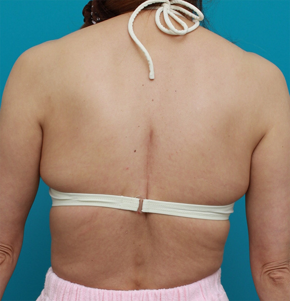 症例写真,ブラジャーの上に乗っかる背中の肉をイタリアン・メソシェイプ（イタリアンメソセラピー）・脂肪溶解注射で除去した症例写真,Before,ba_meso47_b.jpg