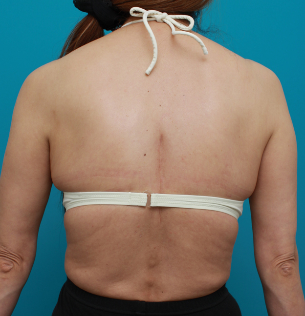 症例写真,ブラジャーの上に乗っかる背中の肉をイタリアン・メソシェイプ（イタリアンメソセラピー）・脂肪溶解注射で除去した症例写真,3回目注射後2週間,mainpic_meso04b.jpg