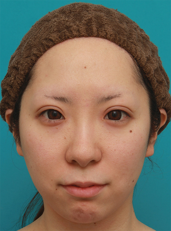 症例写真,小顔専用脂肪溶解注射メソシェイプフェイスを4回注射した症例写真,After（4回目注射後1ヶ月）,ba_meso_face01_b.jpg