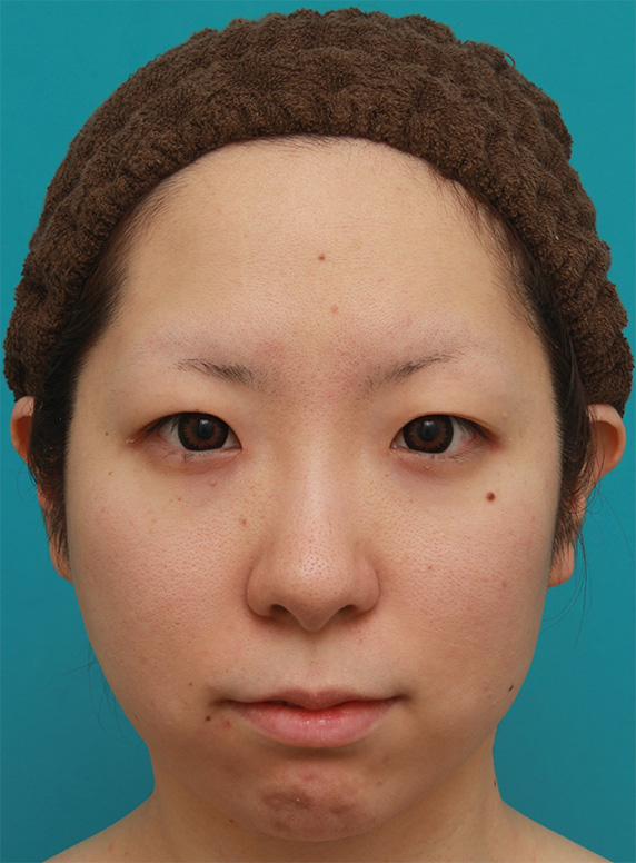 小顔専用脂肪溶解注射メソシェイプフェイスを4回注射した症例写真,Before,ba_meso_face01_b.jpg