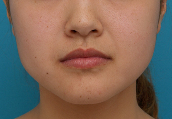 ボツリヌストキシン注射（エラ、プチ小顔術）の症例写真 エラ改善に,Before,ba_votox12_b.jpg